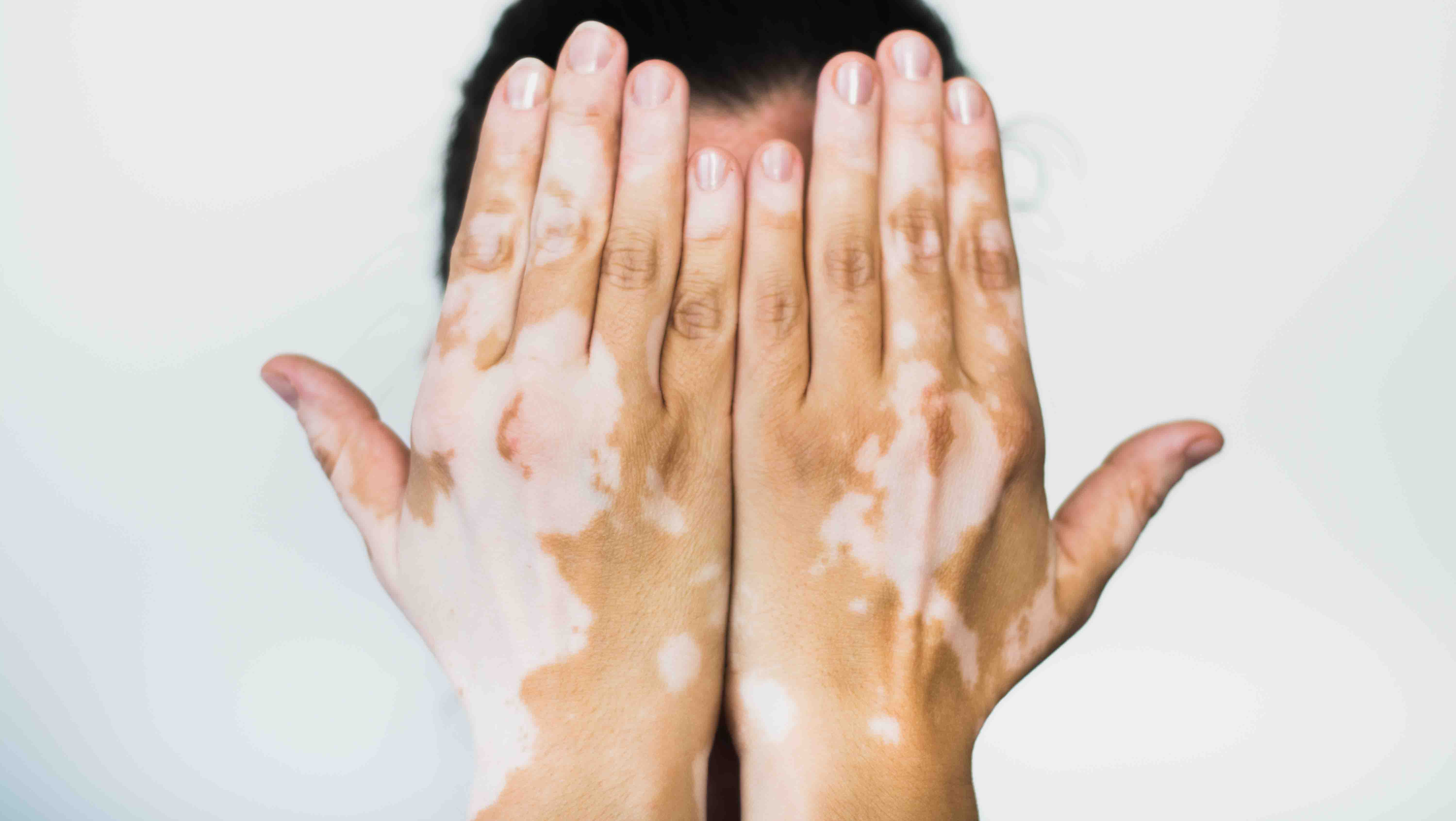 Le vitiligo : ça se soigne - Traitements, soins - Essentiel Santé ...