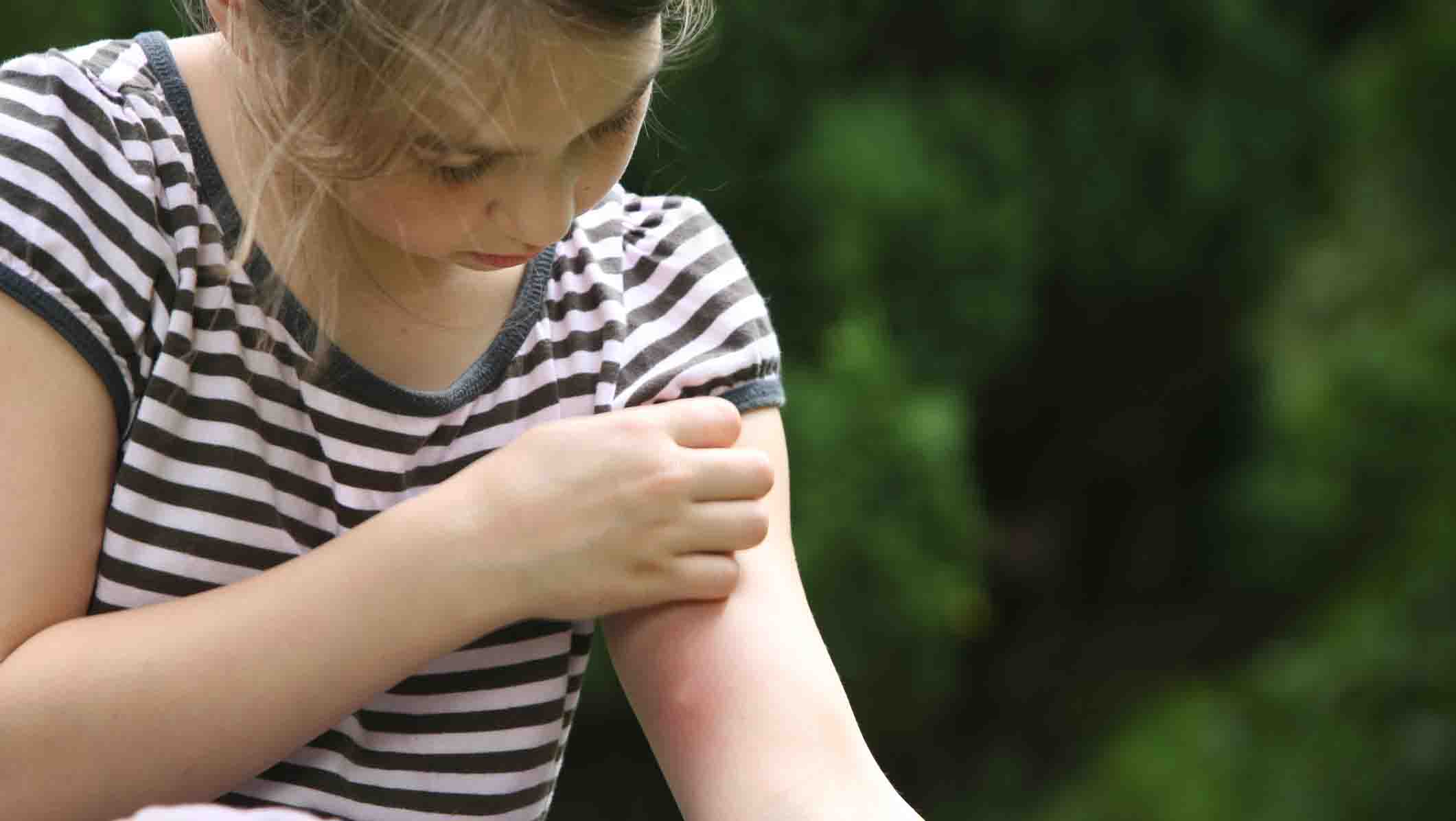 Piqûres de moustiques : ce qu’il faut savoir