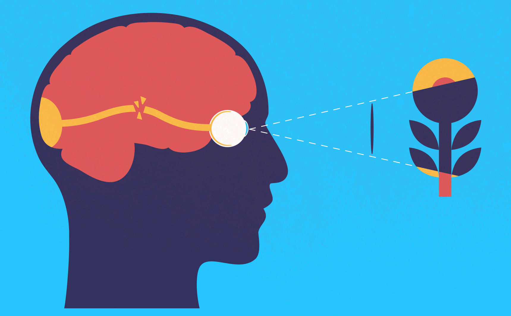 Illustration maladie affectant les nerfs optiques et son impact sur la vision.