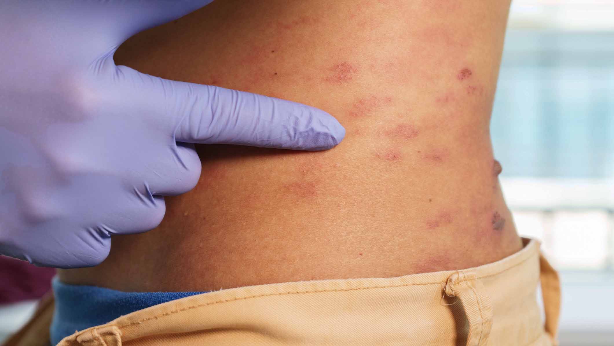 Comment soigner un zona ?