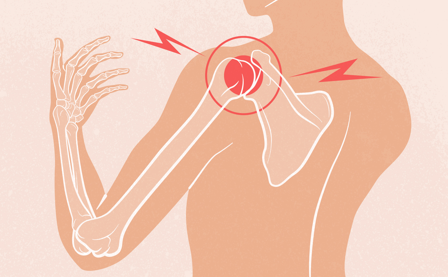 Douleur de l’épaule : quelles causes possibles ?