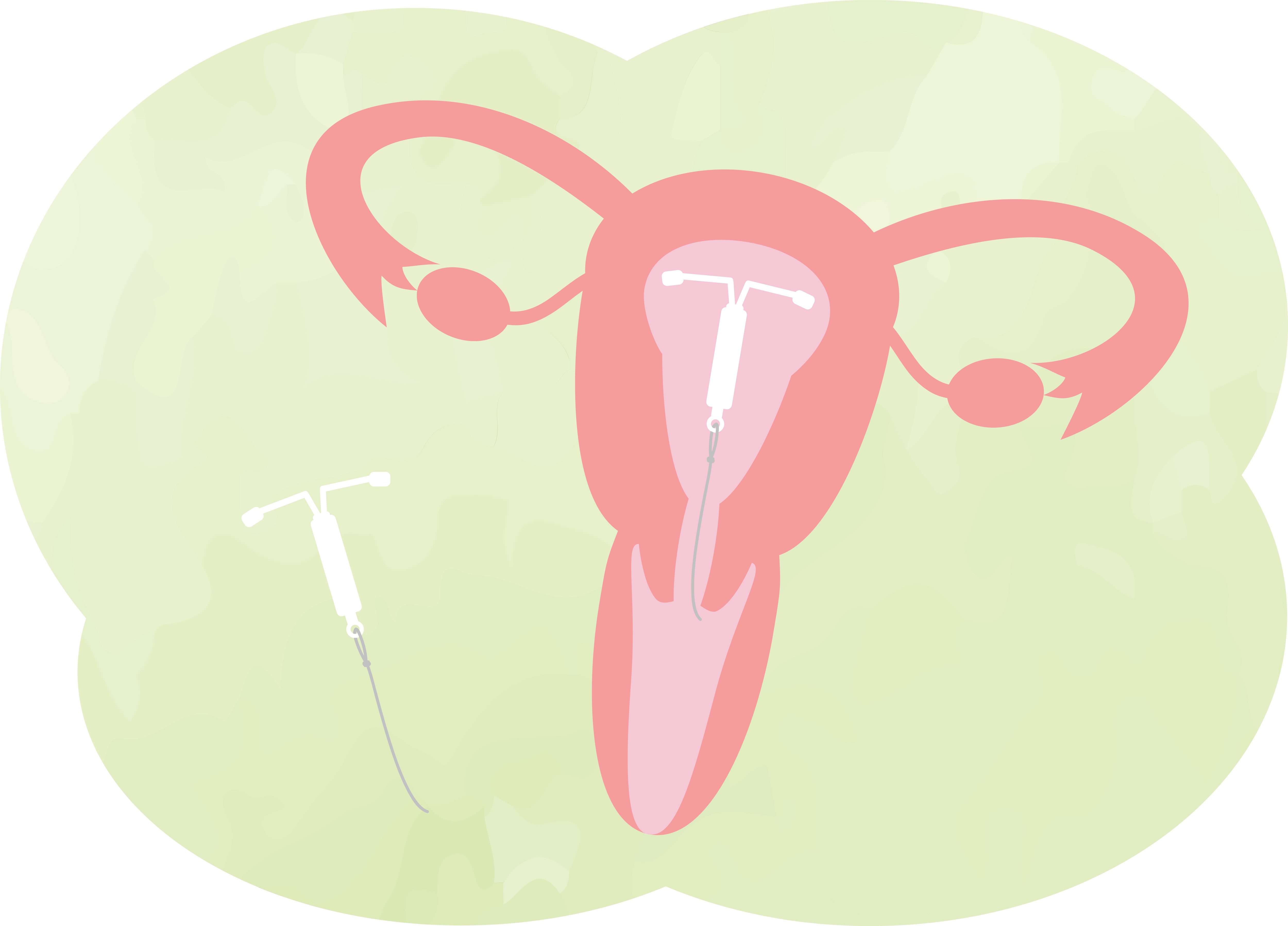 Illustration d'un stérilet placé dans une trompe de fallope.