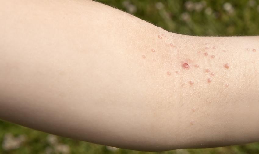 Le molluscum contagiosum : comment traiter cette maladie de peau ...