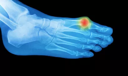 Une crise de goutte, qu’est-ce que c’est ?