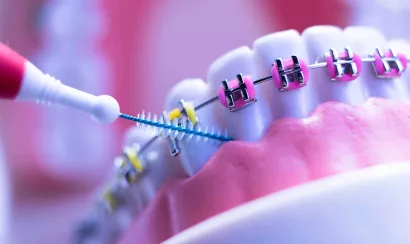 Orthodontie : comment prendre soin de son appareil dentaire ?