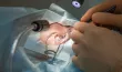 Mieux voir sans lunettes grâce à la chirurgie réfractive